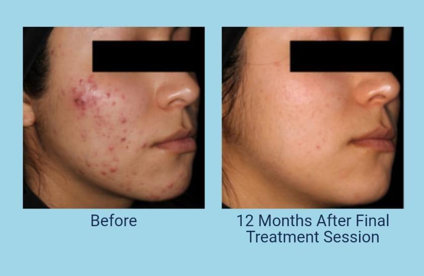 Acne (Pimple) Treatment