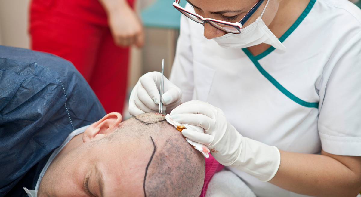 Direct Hair Implantation (DHI)