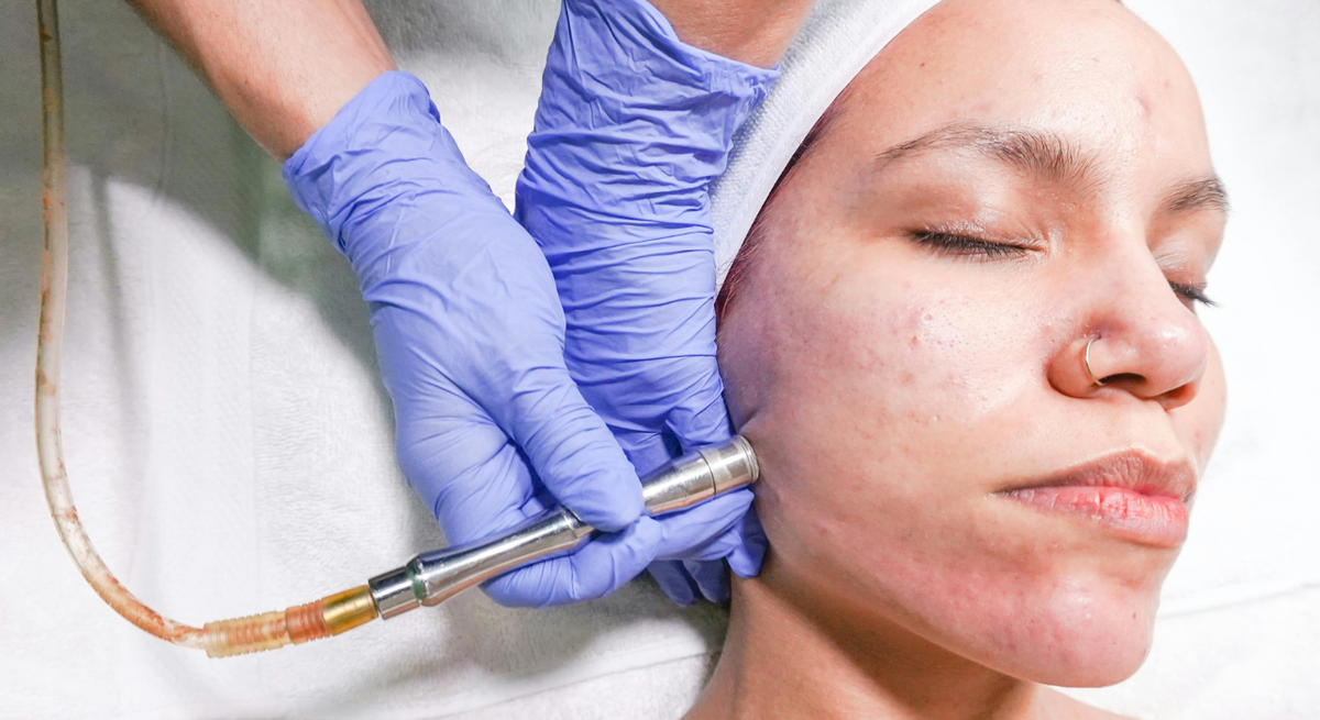 Microdermabrasion