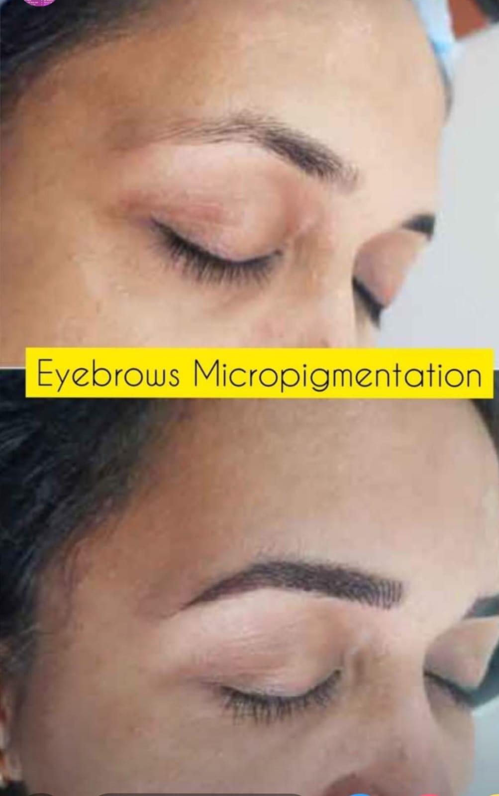 Pigmentation Treatment