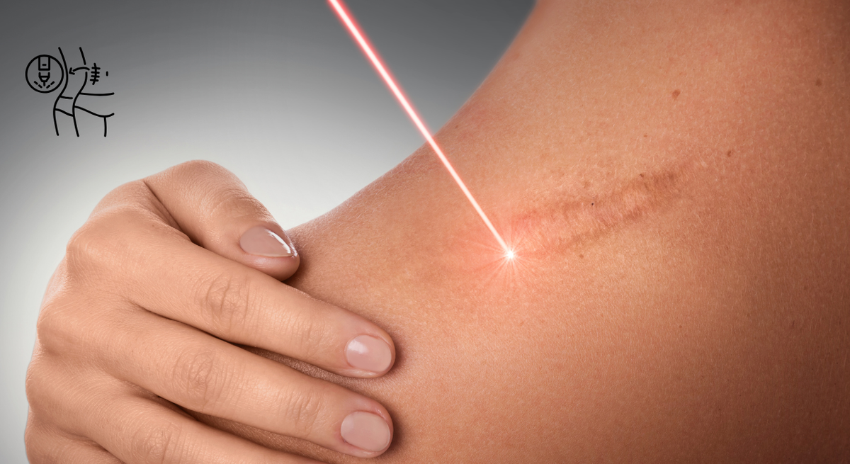 Scar Removal