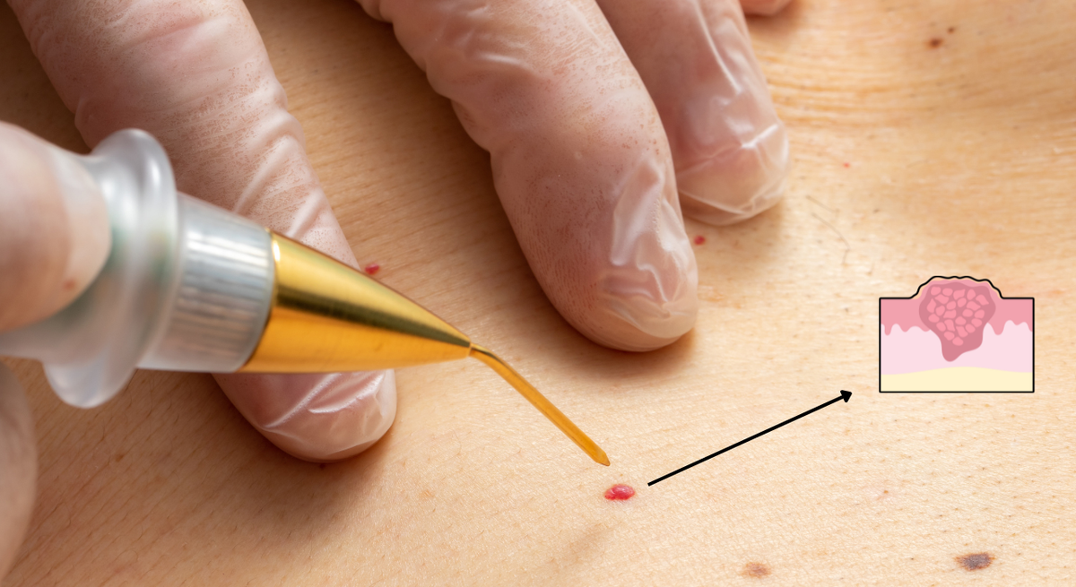 Warts Removal